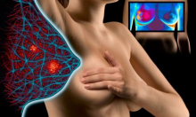 Objavljeni pobjednici natječaja za AI dijagnosticiranje raka dojke