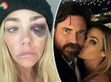 Denise Richards' estranged husband gives new explanation for her black eye as divorce turns messy