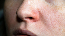 Rote Äderchen im Gesicht: Rosacea-Creme gegen Hautrötungen: Diese Produkte sollen die Symptome lindern