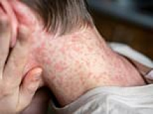 Outbreak fears sweep Australia after a traveller returned home from Bali with a highly contagious infection
