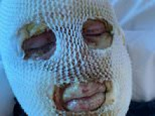 Two cousins suffered horrific facial burns after pub heater explosion, court hears