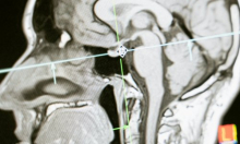 Kina odobrila komercijalnu primjenu čipova za mozak: Osobe s paralizom pokretat će ruke mislima