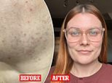 How to end the curse of female facial hair. It's caused by hormones and hard to shift. Now there's a pioneering treatment... and sufferer Georgia says: 'It's the best thing I've ever done'