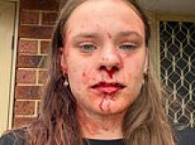 Bashed teen's horrifying injuries after she was attacked by home intruders and left fearing she was 'going to die'