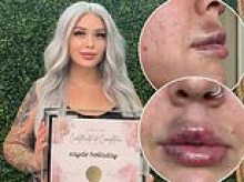Woman left with STIFF lips after booking Botox injector who cops say was a scammer
