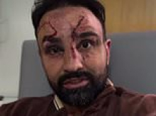 American bare-knuckle boxer attacks NHS staff, who 'wouldn't be allowed to work on farm animals' in the US, as he suffers from infections following his fight