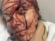 Charlie Teo's girlfriend breaks her silence after suffering horrific injuries