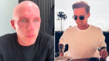 Seltene Krankheit: Influencer verlor alle Haare am Körper – so geht er damit um