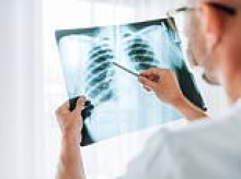 Supermarket scans to spot your cancer: NHS scheme detects thousands more lung cancer cases early