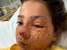 Father's urgent warning after his daughter, 10, suffered horrific burns to her face from viral squishy toy trend popular on TikTok