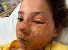 Dad cops nasty backlash after his daughter, 10, suffered horrific burns to her face when her viral squishy toy exploded