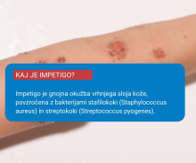 V poletnih mesecih je med otroki pogosta kožna bolezen impetigo