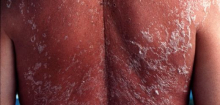 UV-Strahlung: Warum mehr Sonne in Mitteleuropa zum Problem für die Haut wird