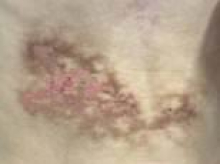 Boy develops terrifying 'toasted skin syndrome' from resting laptop on his body - doctors issue warning