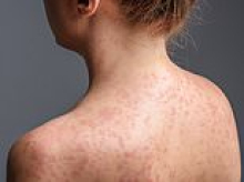 Urgent measles warning for Sydney after infected patient visits popular spots including Kmart