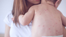 Rekordna epidemija ospica u SAD-u: Ima i sve više mrtvih