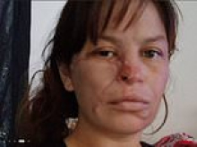 Woman disfigured by pit bull attack while heavily pregnant with twins says she is distressed by strangers' constant stares