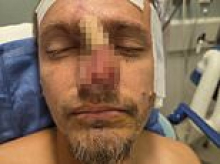 Georgia man left terribly disfigured by his two pet dogs says he doesn't blame them for attack and that he plans to keep them